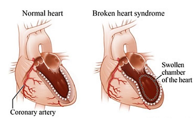 How Broken Heart Syndrome physically changes the heart