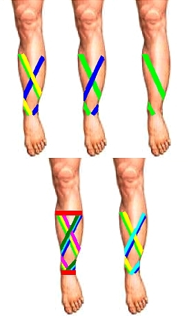 Binding techniques for Shin Splints